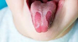 Geographic tongue 