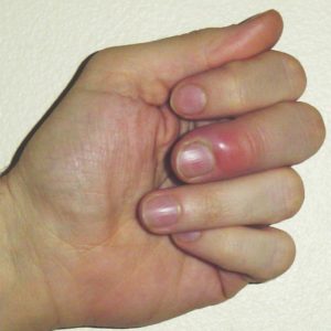 Paronychia