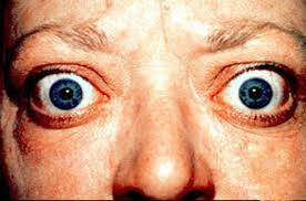 In exophthalmic goiter, the eyes bulge out, while the rest of the symptoms are the same as that in hyperthyroidism.