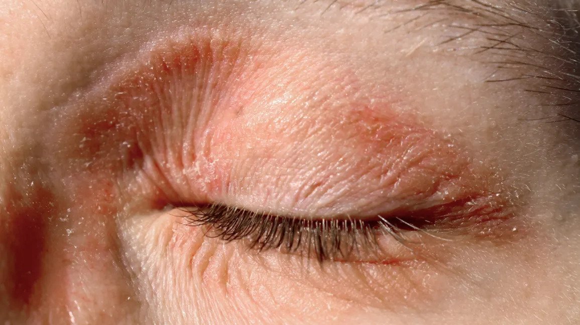 Top 10 Homeopathic Medicines For Eyelid Dermatitis And Its Causes