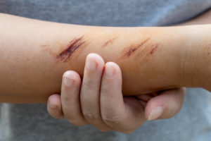 Wound 