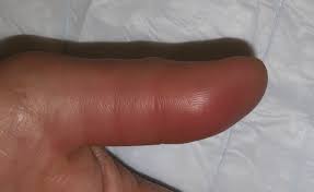 Felon is the subcutaneous abscess of the fingertip pulp.  