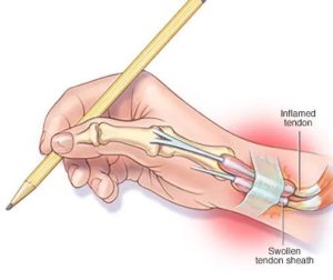 De Quervain's tendinitis