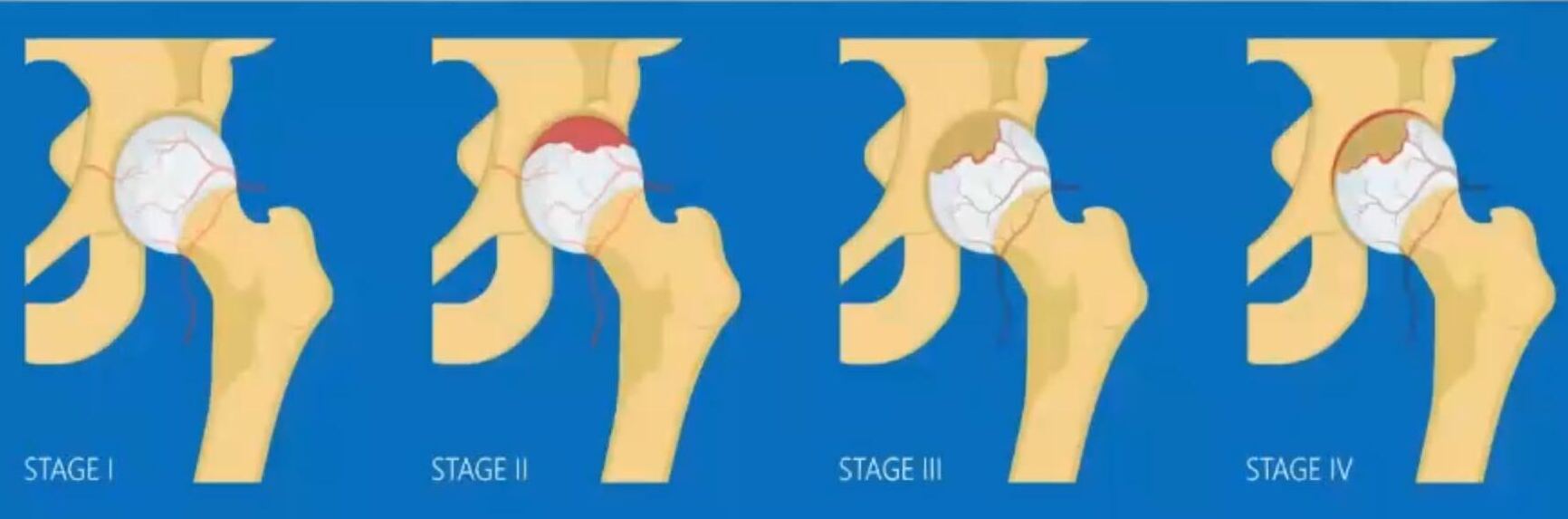 Top 10 Homeopathic Remedies for AVN – Avascular Necrosis Treatment
