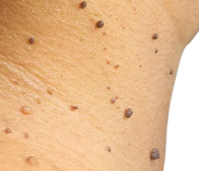 how to get rid of warts on the face