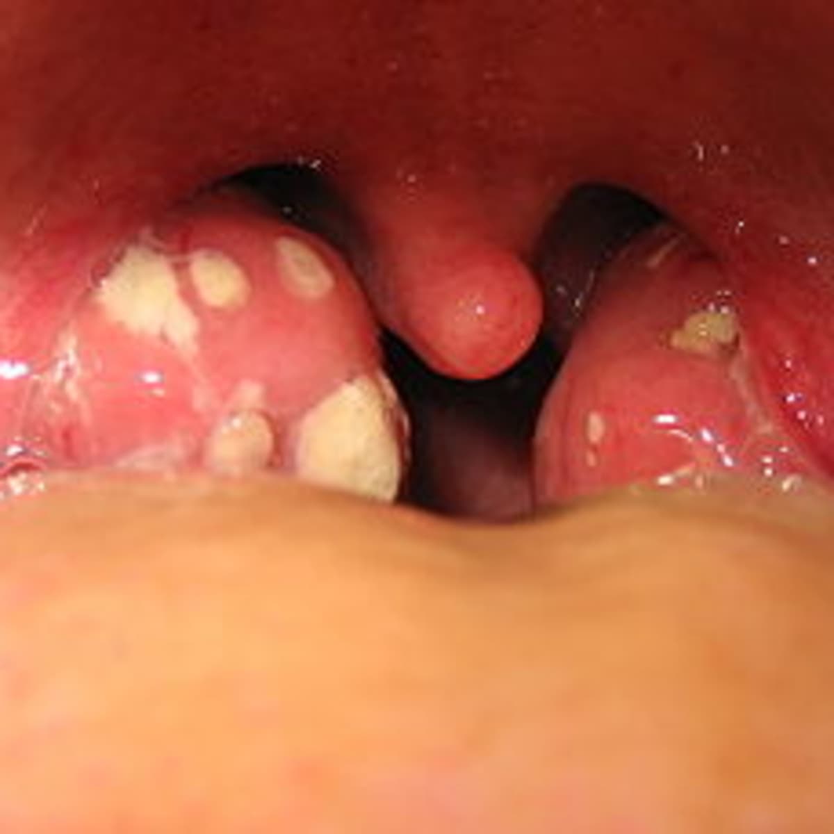 What Causes White Spots On Tonsils And Its Homeopathic Remedies -  Homeopathy at DrHomeo.com