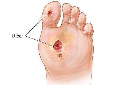 Top 10 Homeopathic Medicines For Diabetic Foot Ulcer